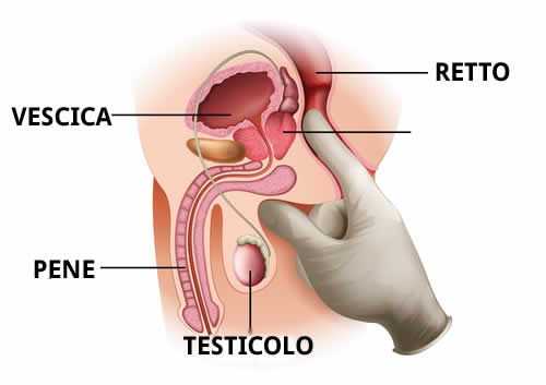 esplorazione rettale prostata