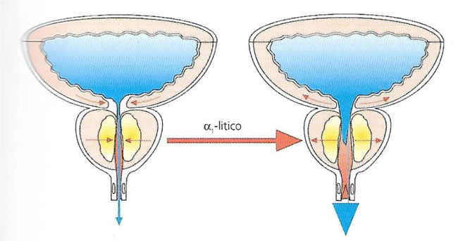 prostata ingrossata medicinali