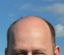 Alopecia testosterone e prostata