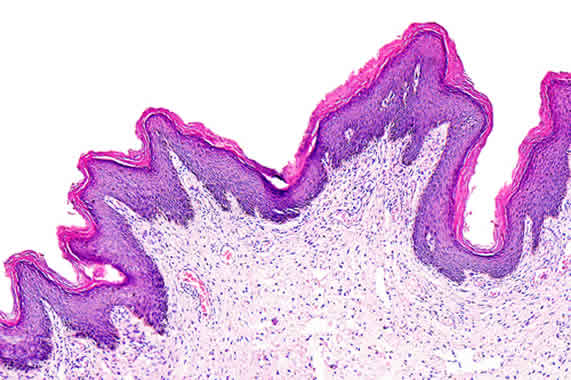 donne e papilloma virus