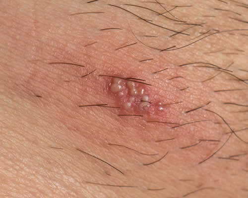 herpes infezioni genitali