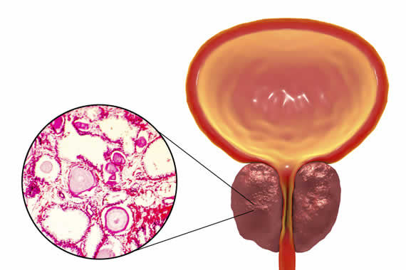 prostata con adenoma bilobato