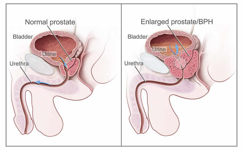 prostata ingrossata rimedi