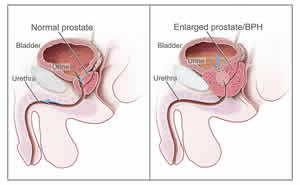 Iperplasia prostatica benigna