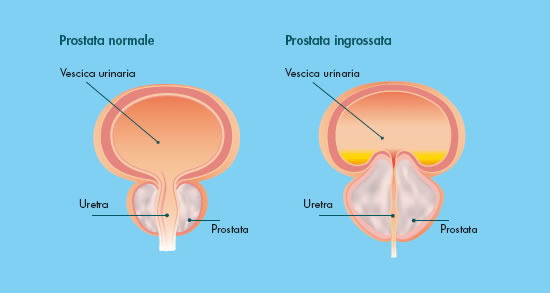 prostata ingrossata misure