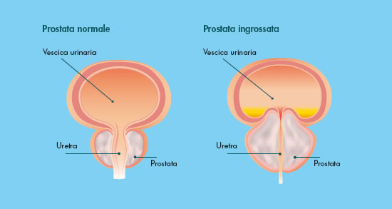 ipertrofia prostatica benigna)