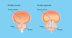 ipertrofia prostatica benigna IPB 1