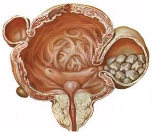 Terapia ipertrofia prostatica Terapia ipertrofia prostatica