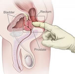 ipertrofia prostatica benigna IPB 3