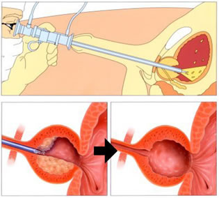 Dieta per ipertrofia prostatica