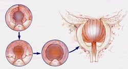 ipertrofia prostatica benigna IPB 5