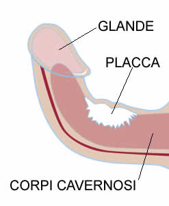 Malattia di Peyronie