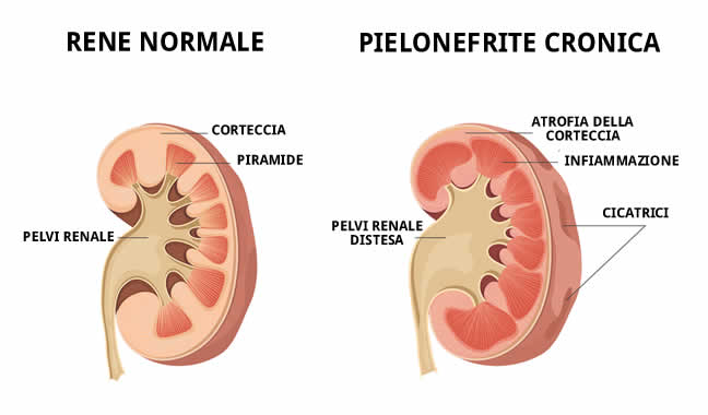 pielonefrite acuta e cronica