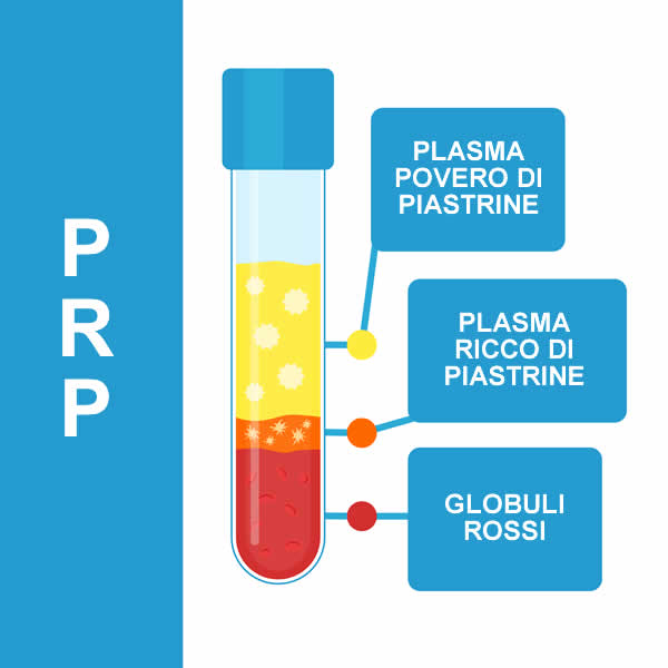 plasma ricco di piastrine PRP