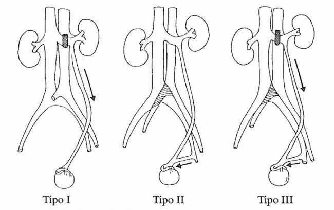 varicocele per problema vena renale