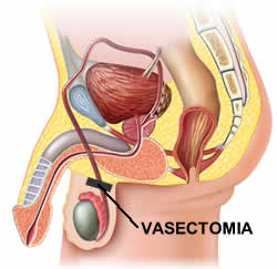 Vasectomia linee guida